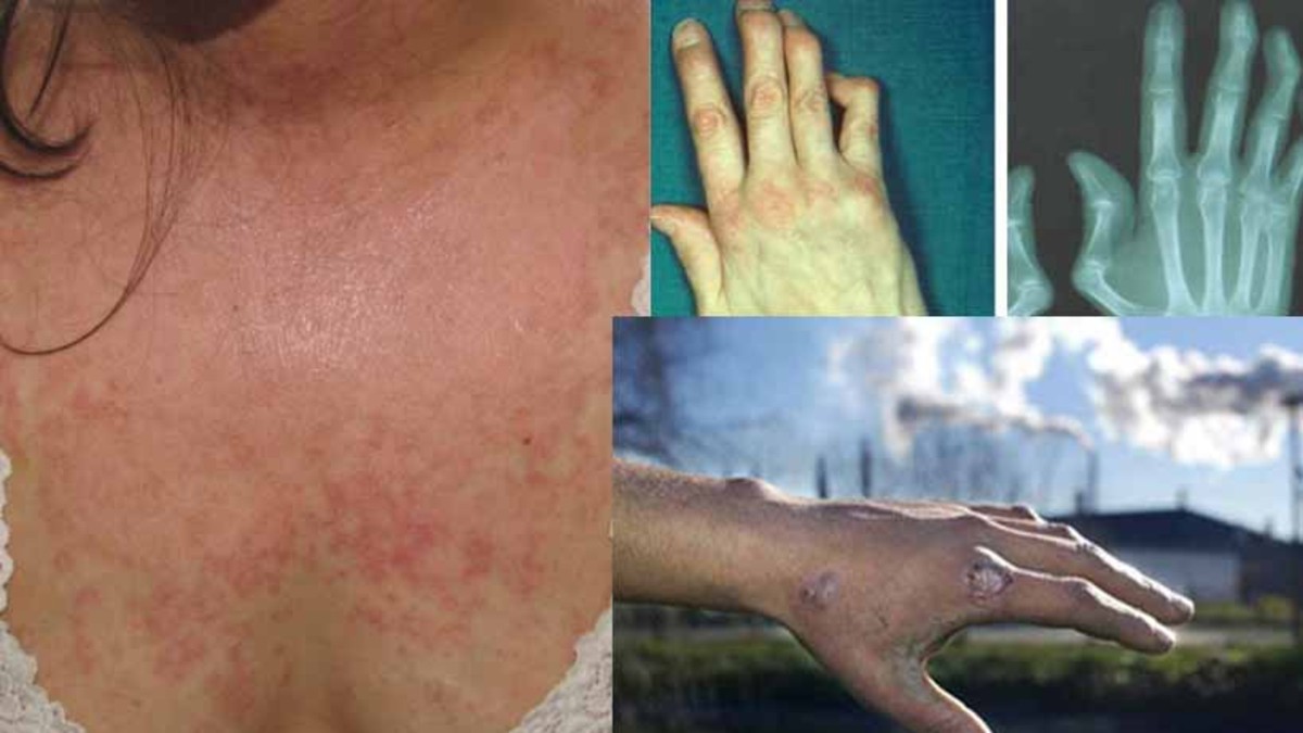 Lupus y púrpura: las pestes que contagia la CEAMSE