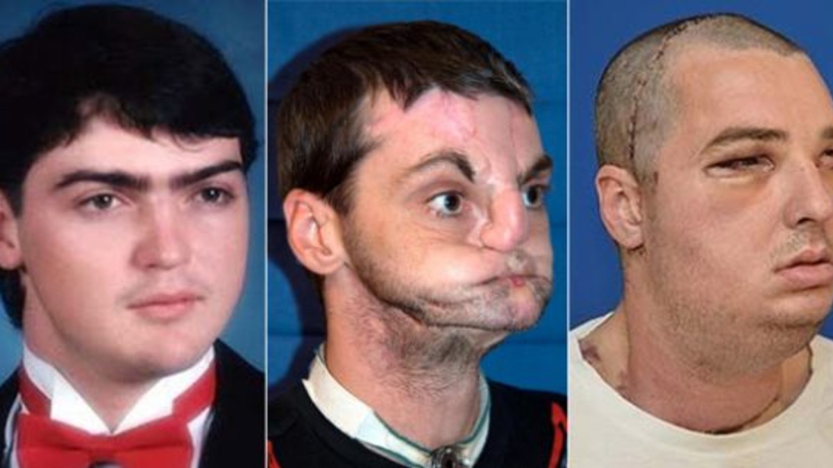 Un sorprendente trasplante de rostro luego de 15 años