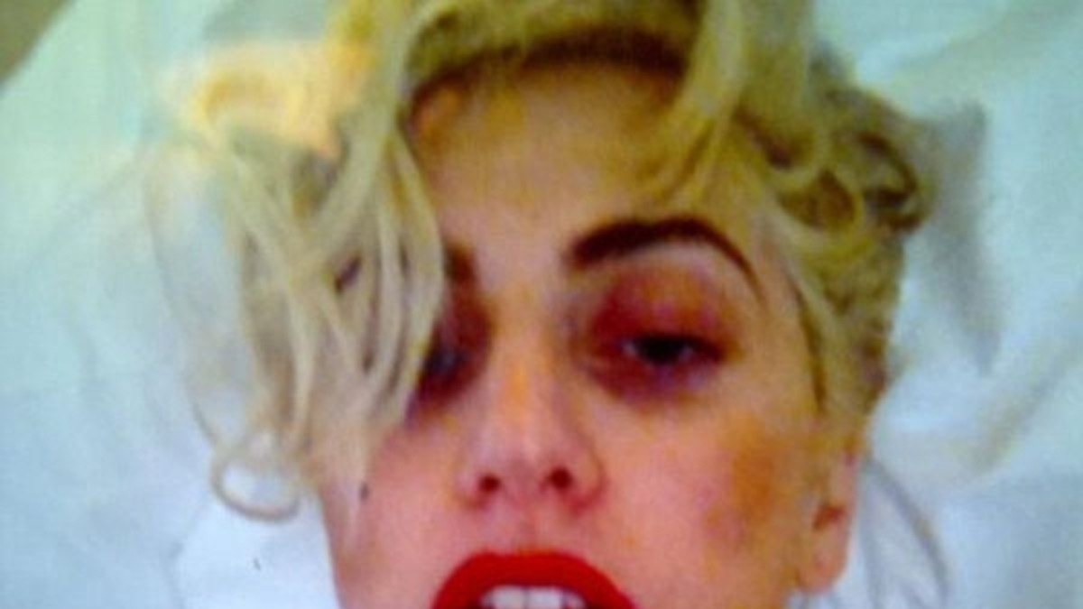 La foto de Lady Gaga luego de su brutal golpe en la cara