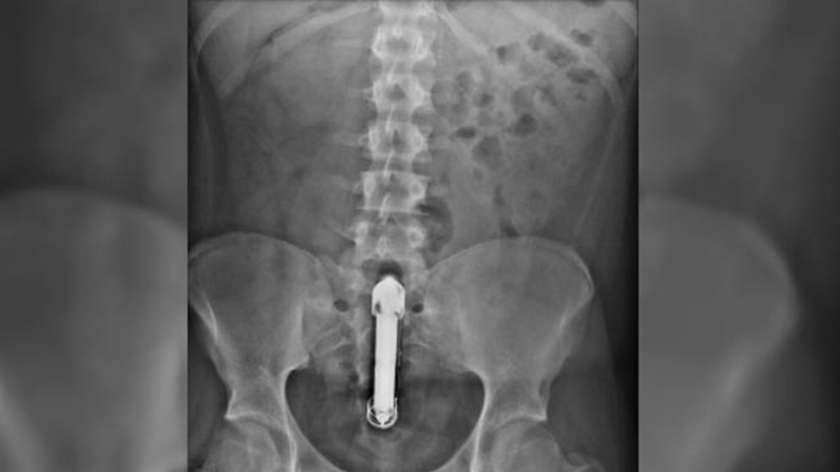 Se le atascó un vibrador y compartió la foto en Twitter