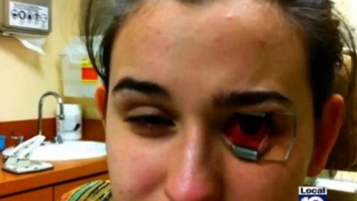 Una bacteria en la lente de contacto casi le come el ojo