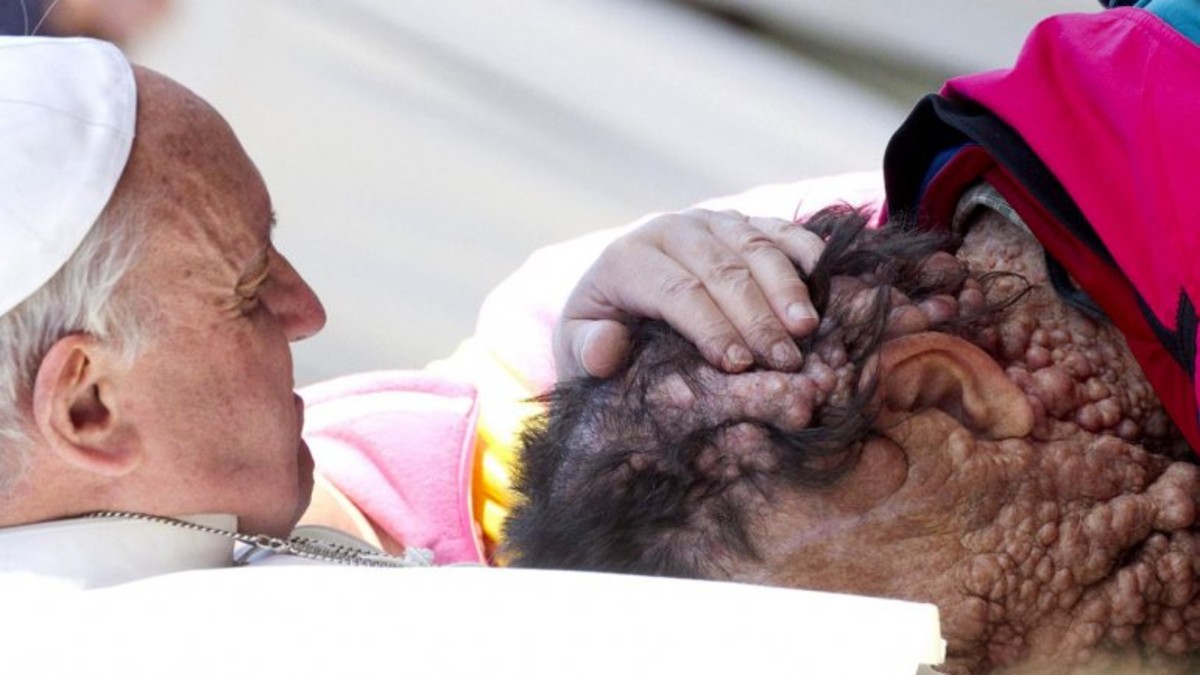 El abrazo del Papa a un hombre con una extraña enfermedad