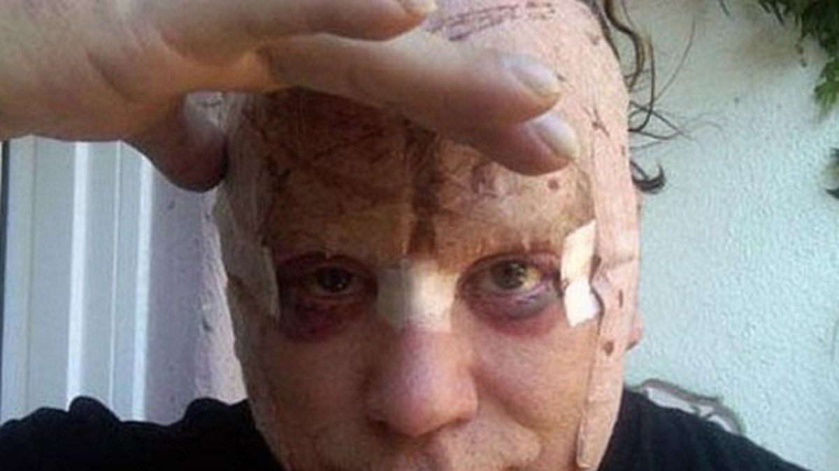 Mickey Rourke no se cansa de estirarse las arrugas