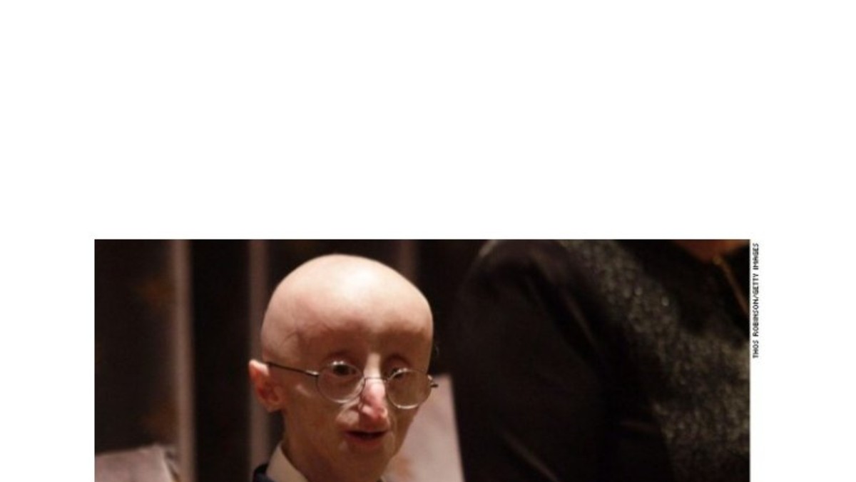 A los 17, murió el "Benjamin Button" de la vida real